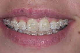 Best product, best price, hot deals How Much Do Braces Cost In The Uk The Dental Guide Uk