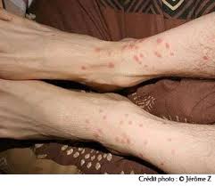 Image result for Trombicula autumnalis bites