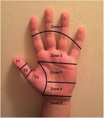 This is the official approximate match mapping between icd9 and icd10, as provided by the general equivalency mapping crosswalk. Flexor Tendon Injuries Physiopedia