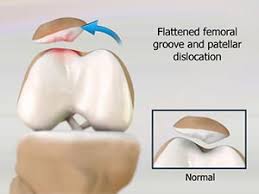 Image result for Patellar Dislocation