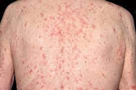 Provigil And Nuvigil Side Effects Skin Rashes Birth Defects