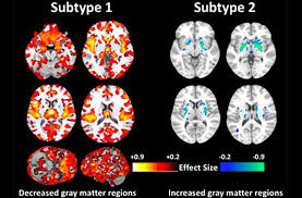 It causes a range of different psychological symptoms. Schizophrenic No More Two Subcategories In The Brain Redefine A Blanket Diagnosis Penn Today