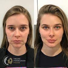 Cheek rejuvenation with dermal filler before & after photos patient 913988. Before After Facial Transformation With Dermal Filler What Do You Think Comment This Procedure Was Facial Aesthetics Facial Fillers Facial Contouring
