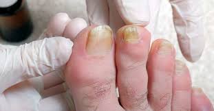 Any variety may be used in a vinegar cure for toenail fungus. Why Are My Toenails Yellow Causes And Treatment