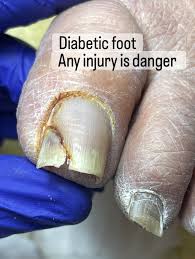 Image result for Beau lines feet