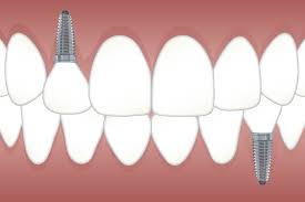 We regret to inform you that there's no possible way to get free dental implants. Ai Helps Predict Treatment Outcomes For Patients With Diseased Dental Implants
