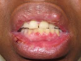 Image result for Mouth ulcers roof of mouth