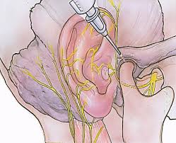 Image result for Ear Nerve Block
