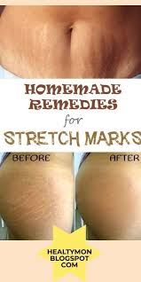 Home Remedies For Stretch Marks How To Clear Stretch Marks How To Get Rid Of S Stretch Mark Remedies Stretch Marks Stretch Marks On Thighs