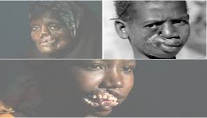 Doctors without Border decry low vaccination against NOMA disease