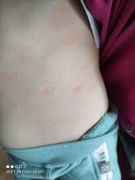 Image result for vyrážka u dětí