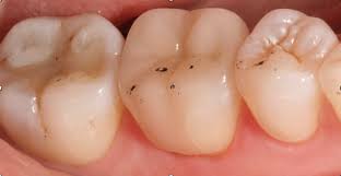 Enhancing The Esthetic Outcome Of Posterior Restorations Practice Management Esthetics Dental