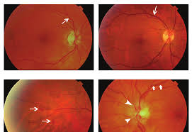 Image result for Hyperviscosity Syndrome