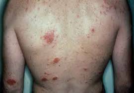 Image result for steps to cure eczema