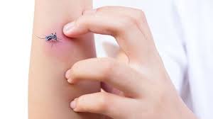 Nah, untuk kamu yang bingung pilih Enam Bahan Yang Ampuh Hilangkan Bekas Gigitan Nyamuk Tribun Jogja