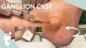 How to remove a cyst medical procedures aftercare and more. Draining A Ganglion Cyst Using A Syringe Youtube