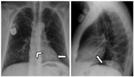 Start studying pacemakers & icds. Kjr Korean Journal Of Radiology