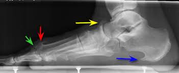 Is part of the bone broken away from the remaining bone? Bone Spur Symptoms Causes Diagnosis Treatment