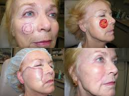 It is mainly performed on certain basal cell carcinoma and squamous cell carcinoma. Mohs Micrographic Surgery Boulder Co Ideal Dermatology Skin Pc