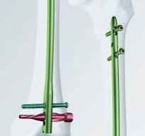 DFN. Distal Femoral Nail.