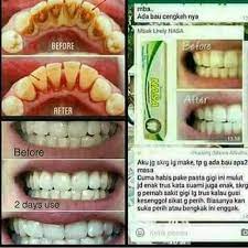 Membunuh bakteri dalam mulut, mencegah perdarahan pada gusi, dan mencegah. Pasta Gigi Nasa Pemutih Home Facebook