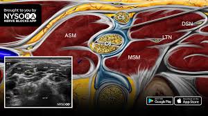 Image result for Superior Trunk Block