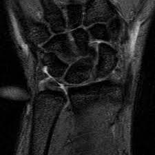 Treatment of injury of the triangular fibrocartilage complex (tfcc). Tfcc Injury Hand Orthobullets
