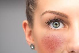 Image result for red rash face