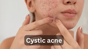 Image result for acne face