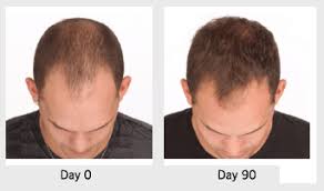 Six common type 3 variations 1. Hair Loss Treatments Swetnam Cosmetic Fayetteville Ar