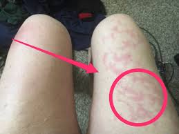 Unusual Skin Symptoms Of Coronavirus Covid Toes Blisters Business Insider