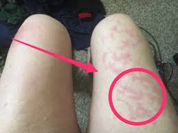 Prevention and home treatment for red spots on legs. Unusual Skin Symptoms Of Coronavirus Covid Toes Blisters
