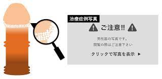 20代、亀頭のぶつぶつ（真珠様陰茎小丘疹）