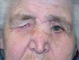 Extreme Cancer of the Periorbital Region