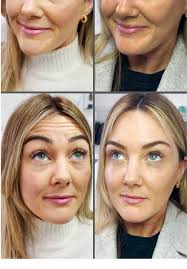 Anti-Wrinkle Before and Afters! A glow up after pregnancy and her skin is  looking so smooth 🤩 #beforeandafter #glowup #aestheticinjector  #antiwrinkletreatment #injectorsoftiktok