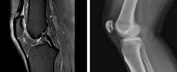 Abnormal anatomy with normal signal, i.e. Why Do I Need A Knee Mri Wake Radiology