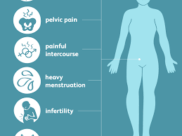 Quali sono le cause dell'endometriosi? Symptoms Of Endometriosis
