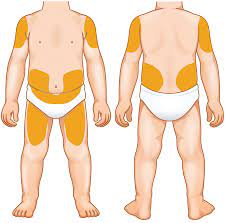 Shop for kitchen tools newest collections only at ikea indonesia. Kineret Anakinra Official Website Using Kineret For Nomid