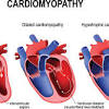 Learn more about myocarditis and pericarditis 1