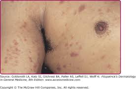 Image result for skin rash acute hiv infection