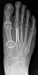 Distal radius fractures programme online course: Metatarsal Morphology And Injury Risk In Runners Lower Extremity Review Magazine