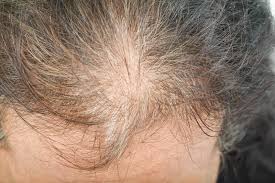 What kind of healthcare provider treats hair loss? Once Daily Combination Treatment Effective For Female Pattern Hair Loss Dermatology Advisor