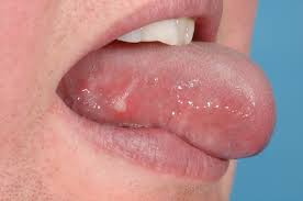 Image result for mouth ulcer on tongue)