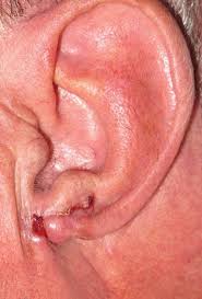 Skin cancer is one of the most common types of cancer. Basal Cell Carcinoma Of The Earlobe Download Scientific Diagram