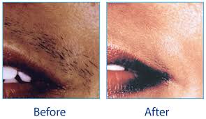 This isn't to say that ipl lasers can't successfully remove hair on the face and body. Ipl And Laser Hair Removal Confident Bodies