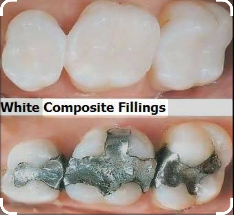 COMPOSITE FILLING product image