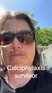 #calciphylaxis#survivor#fyp#God#esrd