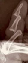 Image result for Lateral PIP Dislocation