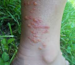 Image result for contact dermatitis