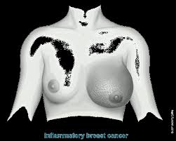 Anyone who has been pregnant knows that tender and most people are aware of symptoms of menopause such as hot flashes, vaginal dryness and night sweats. Inflammatory Breast Cancer Details Diagnosis And Signs